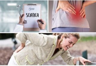 Sciatica fisioterapia